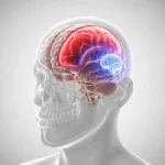 L’Hématome Sous-Dural : Comprendre, Prévenir et Agir