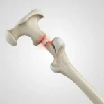 Comprendre la Fracture du Col du Fémur : Causes, Traitements et Récupération